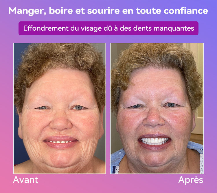 𝐉𝐚𝐬𝐬𝐞𝐞𝐦® Dernières Prothèses Dentaires Premium Confort🎉 (Prothèses haut de gamme, Confortables à Porter - Remise de 70% pour une durée limitée)🔥