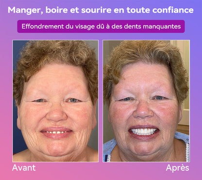 𝐉𝐚𝐬𝐬𝐞𝐞𝐦® Dernières Prothèses Dentaires Premium Confort🎉 (Prothèses haut de gamme, Confortables à Porter - Remise de 70% pour une durée limitée)🔥